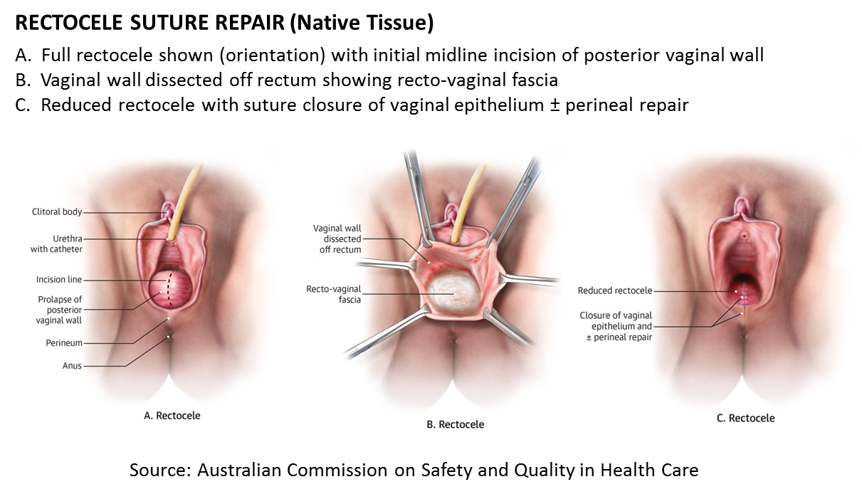 Posterior Vaginal Prolapse